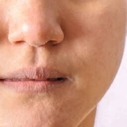 Close up of a person with dry nose