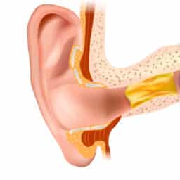 Illustration of earwax in the ear canal