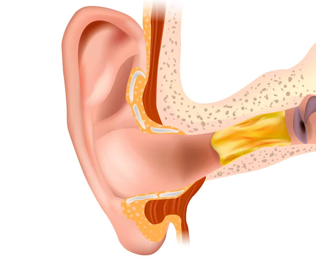 Illustration of earwax in the ear canal.